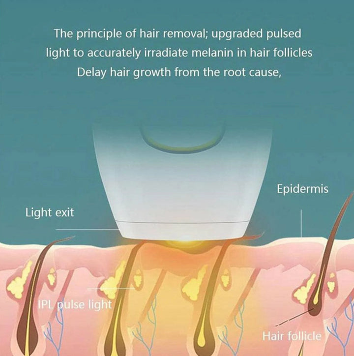 Educational illustration explaining the technology behind laser hair removal