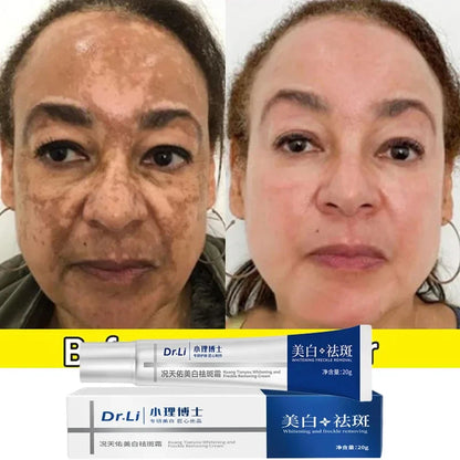 Whitening Freckles Cream - health and beauty, skin care